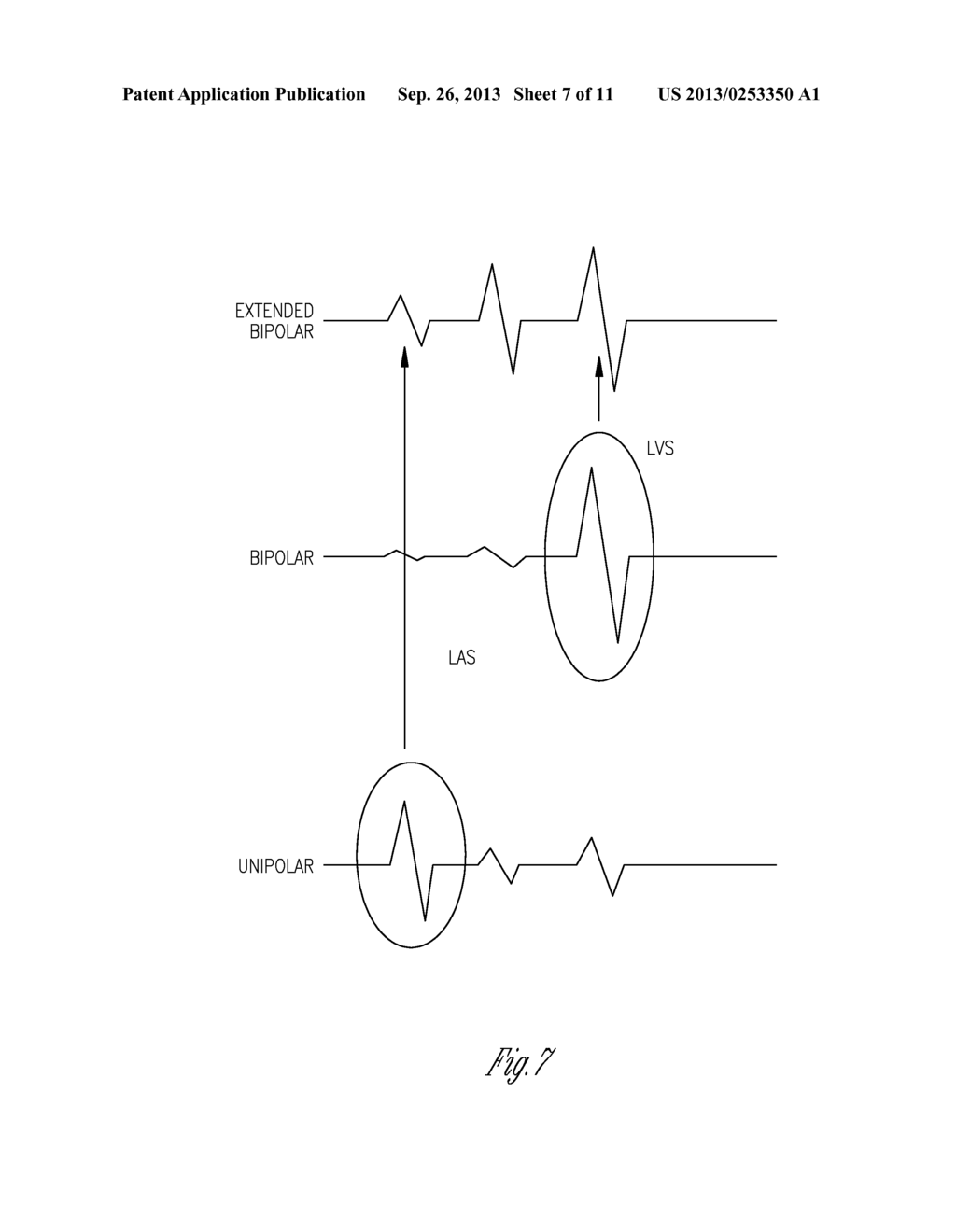 METHOD AND APPARATUS FOR RECOGNIZING SENSED CARDIAC EVENTS USING DIFFERENT     ELECTRODE CONFIGURATIONS - diagram, schematic, and image 08