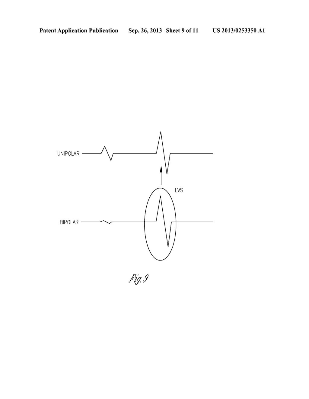 METHOD AND APPARATUS FOR RECOGNIZING SENSED CARDIAC EVENTS USING DIFFERENT     ELECTRODE CONFIGURATIONS - diagram, schematic, and image 10