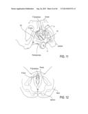 METHOD AND APPARATUS FOR PREVENTING VAGINAL LACERATIONS DURING CHILDBIRTH diagram and image