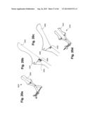 METHOD AND APPARATUS FOR PREVENTING VAGINAL LACERATIONS DURING CHILDBIRTH diagram and image