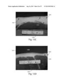 SYSTEMS FOR AFFECTING SUBCUTANEOUS LIPID-RICH CELLS, SYSTEMS FOR REMOVING     HEAT FROM SUBCUTANEOUS LIPID-RICH CELLS, AND SYSTEMS FOR REDUCING     SUBCUTANEOUS LIPID-RICH CELLS diagram and image