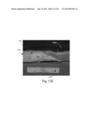 SYSTEMS FOR AFFECTING SUBCUTANEOUS LIPID-RICH CELLS, SYSTEMS FOR REMOVING     HEAT FROM SUBCUTANEOUS LIPID-RICH CELLS, AND SYSTEMS FOR REDUCING     SUBCUTANEOUS LIPID-RICH CELLS diagram and image