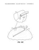 OCULAR DELIVERY SYSTEMS AND METHODS diagram and image