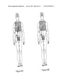 IMPLANTABLE FLUID MANAGEMENT DEVICE FOR THE REMOVAL OF EXCESS FLUID diagram and image