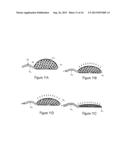 IMPLANTABLE FLUID MANAGEMENT DEVICE FOR THE REMOVAL OF EXCESS FLUID diagram and image