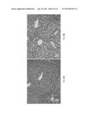 IRREVERSIBLE ELECTROPORATION USING TISSUE VASCULATURE TO TREAT ABERRANT     CELL MASSES OR CREATE TISSUE SCAFFOLDS diagram and image