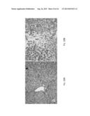 IRREVERSIBLE ELECTROPORATION USING TISSUE VASCULATURE TO TREAT ABERRANT     CELL MASSES OR CREATE TISSUE SCAFFOLDS diagram and image