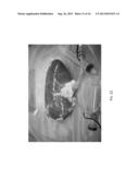 IRREVERSIBLE ELECTROPORATION USING TISSUE VASCULATURE TO TREAT ABERRANT     CELL MASSES OR CREATE TISSUE SCAFFOLDS diagram and image