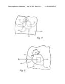 MEDICAL DEVICES TO FACILITATE TISSUE STABILIZATION FOR HEART FAILURE diagram and image