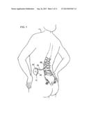 NEEDLE PLACEMENT SYSTEM diagram and image