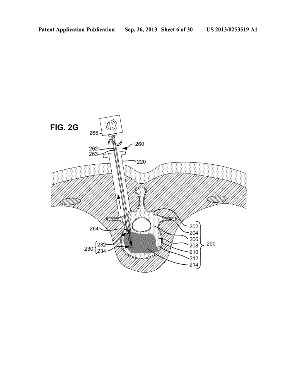 SYSTEM AND METHOD FOR CREATING A BORE AND IMPLANTING A BONE SCREW IN A     VERTEBRA - diagram, schematic, and image 07