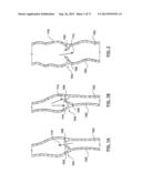 Percutaneous Methods and Apparatus for Creating Native Tissue Venous     Valves diagram and image