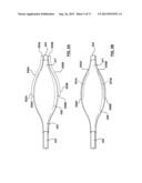 Percutaneous Methods and Apparatus for Creating Native Tissue Venous     Valves diagram and image