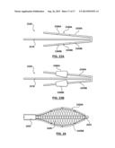 Percutaneous Methods and Apparatus for Creating Native Tissue Venous     Valves diagram and image