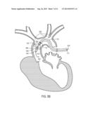 APPARATUS AND METHODS FOR FILTERING EMBOLI DURING PERCUTANEOUS AORTIC     VALVE REPLACEMENT AND REPAIR PROCEDURES WITH FILTRATION SYSTEM COUPLED     IN-SITU TO DISTAL END OF SHEATH diagram and image