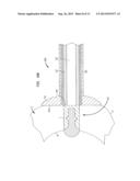 APEX CLOSURE DEVICE diagram and image