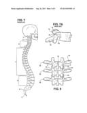 IMPLANT FOR PROVIDING INTER-VERTEBRAL SUPPORT AND FOR RELIEVING PINCHING     OF THE SPINAL NERVES diagram and image
