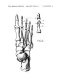 METHOD OF OSTEOSYNTHESES OR ARTHRODESES OF TWO- BONE PARTS, IN PARTICULAR     OF THE HAND AND / OR FOOT diagram and image