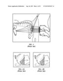 System For Stimulating A Hypoglossal Nerve For Controlling The Position Of     A Patient s Tongue diagram and image