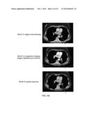 DDR2 Mutations in Squamous Cell Lung Cancer diagram and image