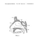 Devices and Methods for Dilating a Paranasal Sinus Opening and for     Treating Sinusitis diagram and image