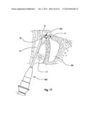 Devices and Methods for Dilating a Paranasal Sinus Opening and for     Treating Sinusitis diagram and image