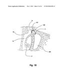 Devices and Methods for Dilating a Paranasal Sinus Opening and for     Treating Sinusitis diagram and image