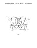 COMPUTER-GUIDED SYSTEM FOR ORIENTING A PROSTHETIC ACETABULAR CUP IN THE     ACETABULUM DURING TOTAL HIP REPLACEMENT SURGERY diagram and image