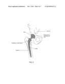 COMPUTER-GUIDED SYSTEM FOR ORIENTING A PROSTHETIC ACETABULAR CUP IN THE     ACETABULUM DURING TOTAL HIP REPLACEMENT SURGERY diagram and image