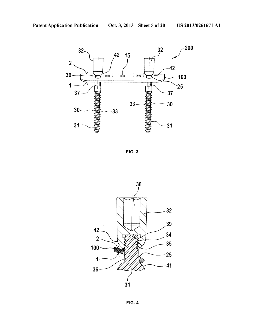 DEVICE FOR BONE REGENERATION AND BONE DISTRACTION - diagram, schematic, and image 06