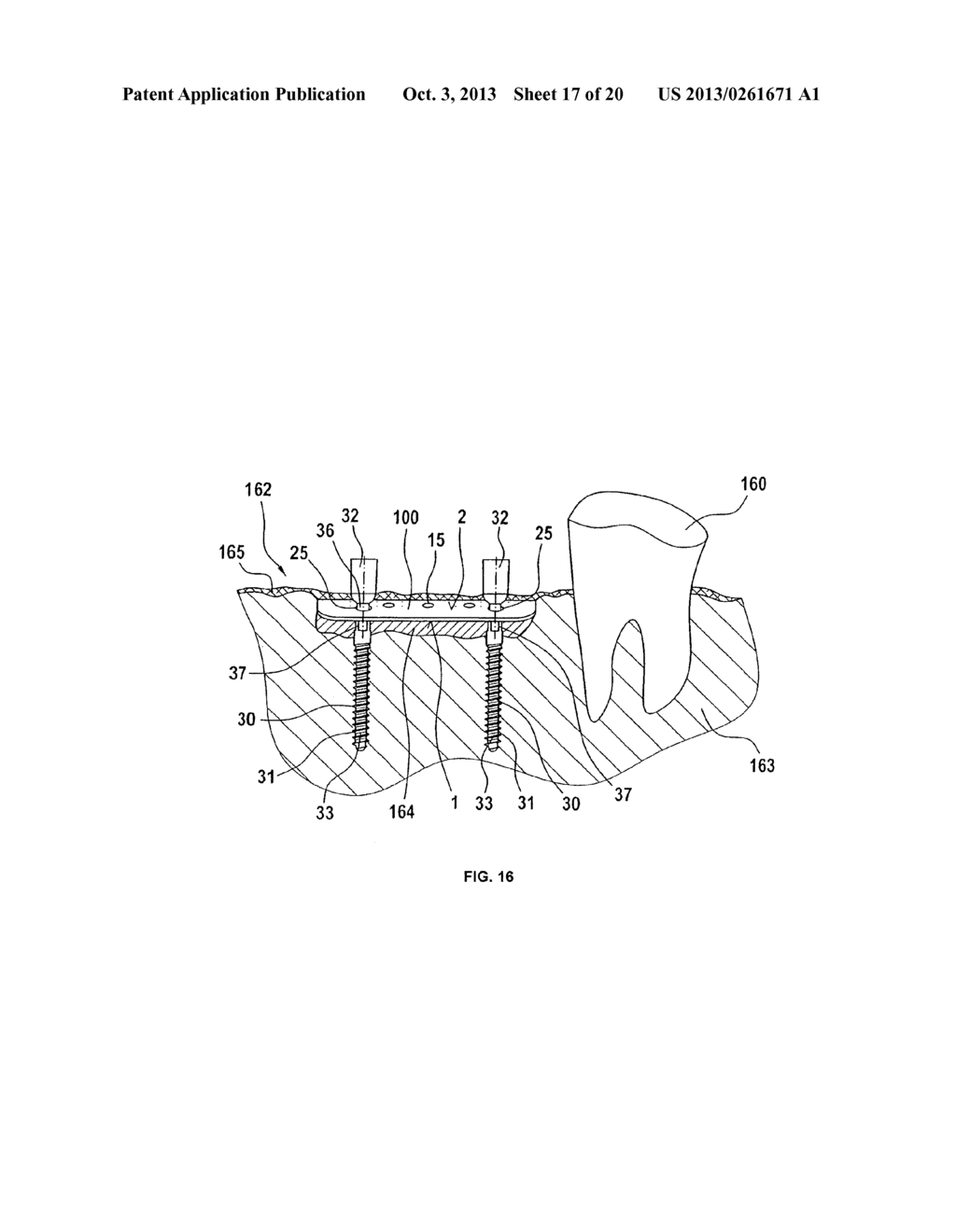 DEVICE FOR BONE REGENERATION AND BONE DISTRACTION - diagram, schematic, and image 18