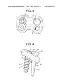 QUAD ANCHOR LATERAL VERTEBRAL BODY FIXATION PLATES diagram and image