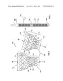 Dual Valve Prosthesis for Transcatheter Valve Implantation diagram and image