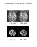 METHOD FOR DELINEATION OF TISSUE LESIONS diagram and image