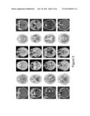 IMAGING OF MENINGIOMAS USING PHINGYLBENZOTHIAZOLE, STILBENE, OR     BIPHENYLALKYNE DERIVATIVES diagram and image