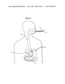 SYSTEMS AND METHODS FOR TREATING OBESITY AND TYPE 2 DIABETES diagram and image