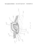 SINGLE PLANE TISSUE REPAIR PATCH diagram and image