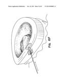 METHOD FOR THE TREATMENT OF TISSUE diagram and image