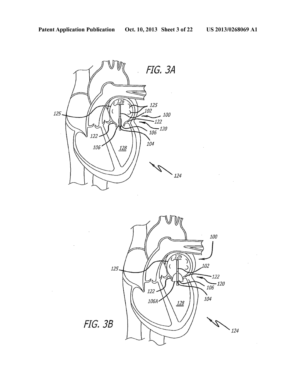 DEVICE AND METHOD FOR REDUCING MITRAL VALVE REGURGITATION - diagram, schematic, and image 04