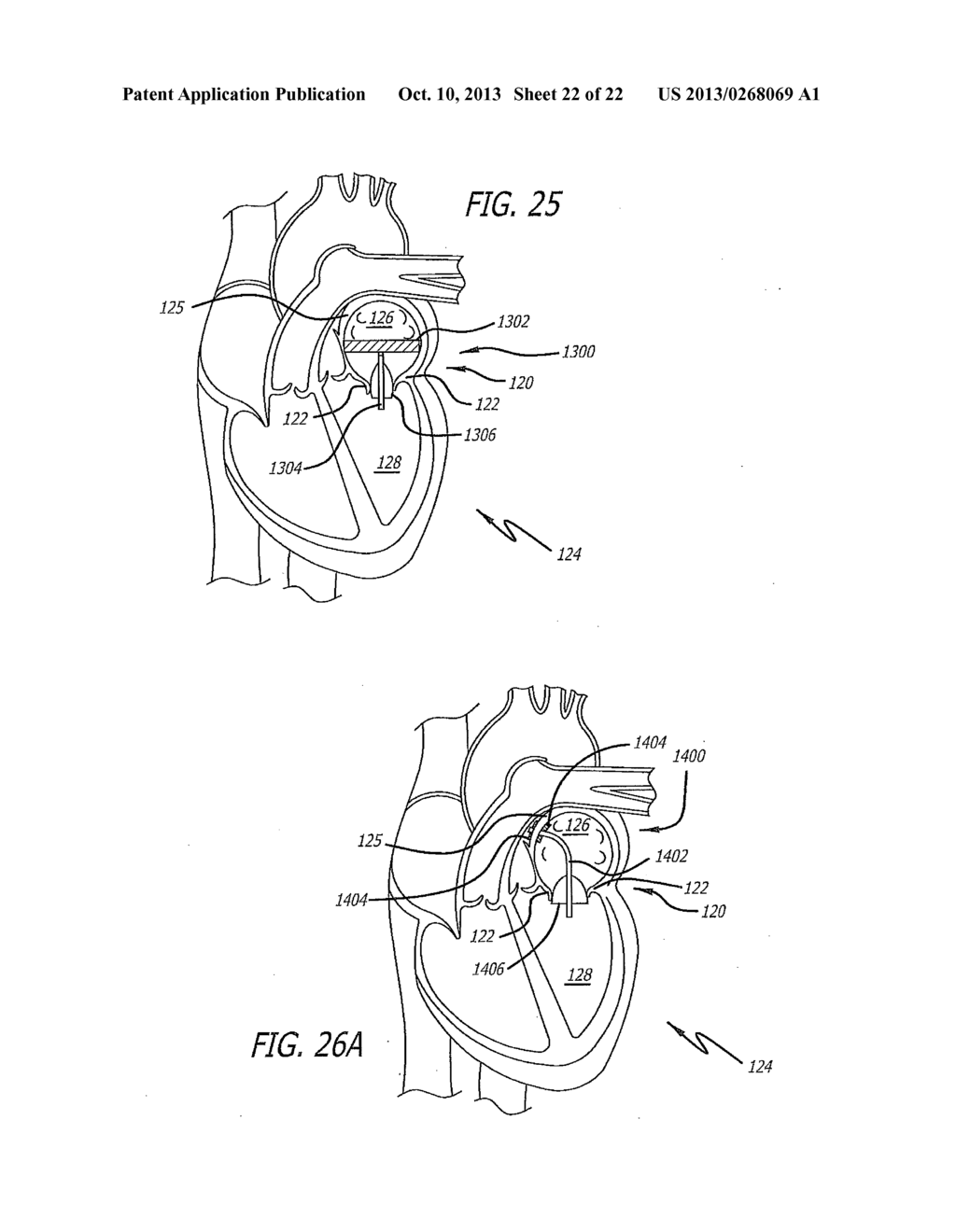 DEVICE AND METHOD FOR REDUCING MITRAL VALVE REGURGITATION - diagram, schematic, and image 23