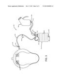 Urine Collection Device diagram and image