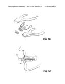 METHOD AND DEVICE FOR INCREASING BONE DENSITY IN THE MOUTH diagram and image