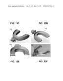 METHOD AND DEVICE FOR INCREASING BONE DENSITY IN THE MOUTH diagram and image