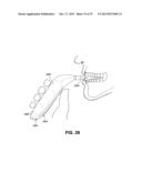 METHOD AND DEVICE FOR INCREASING BONE DENSITY IN THE MOUTH diagram and image