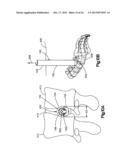 DETACHABLE DILATOR BLADE diagram and image