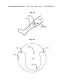 APPURTENANCES TO CAVITY WOUND DRESSINGS diagram and image