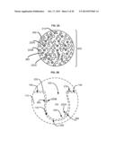 APPURTENANCES TO CAVITY WOUND DRESSINGS diagram and image