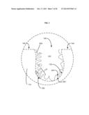 APPURTENANCES TO CAVITY WOUND DRESSINGS diagram and image