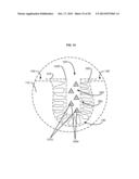 APPURTENANCES TO CAVITY WOUND DRESSINGS diagram and image