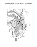 ELECTRONIC PELVIC ORGAN PROLAPSE QUANTIFICATION SYSTEM diagram and image